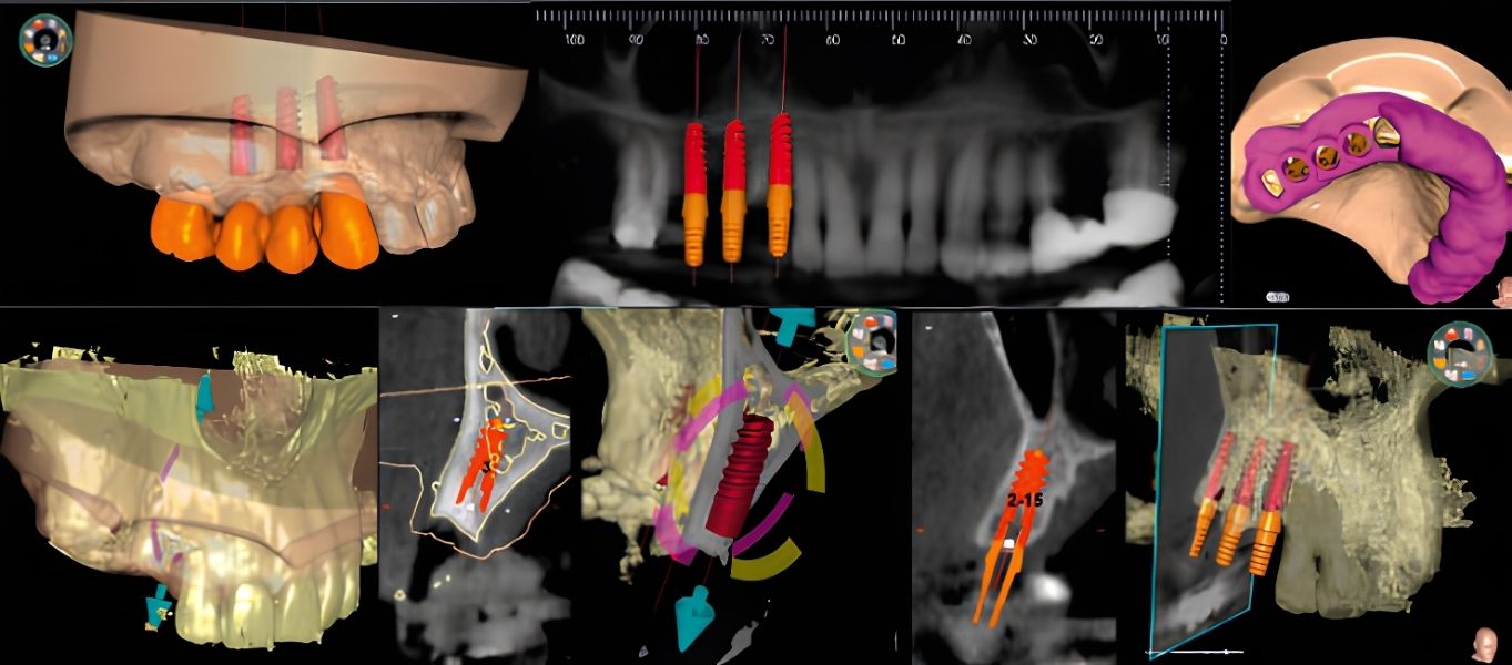 MyRay Hyperion X9 Pro hỗ trợ lập kế hoạch Implant 3D bằng cách kết hợp dữ liệu CBCT và file STL từ máy scan trong miệng trên nền tảng Digital Workflow.