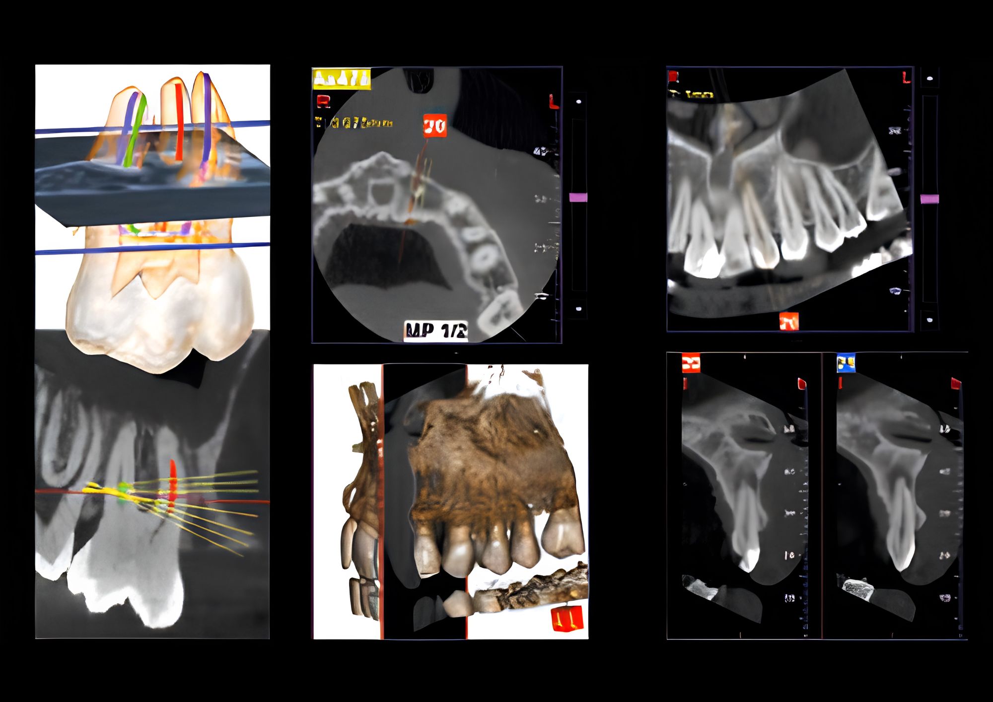 Hình ảnh CBCT nội nha từ MyRay Hyperion X9 Pro với độ phân giải 68 µm hỗ trợ quan sát ống tủy, vi nứt chân răng và tiêu chân răng trong chẩn đoán Endodontics.