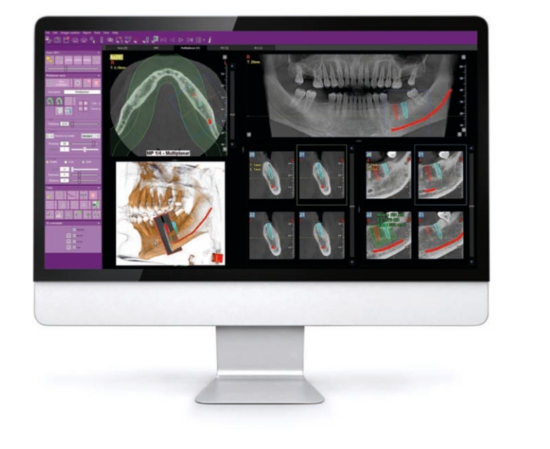 Giao diện phần mềm MyRay iRYS quản lý hình ảnh Panorama 2D, CBCT 3D và Cephalometric trong Digital Workflow nha khoa.