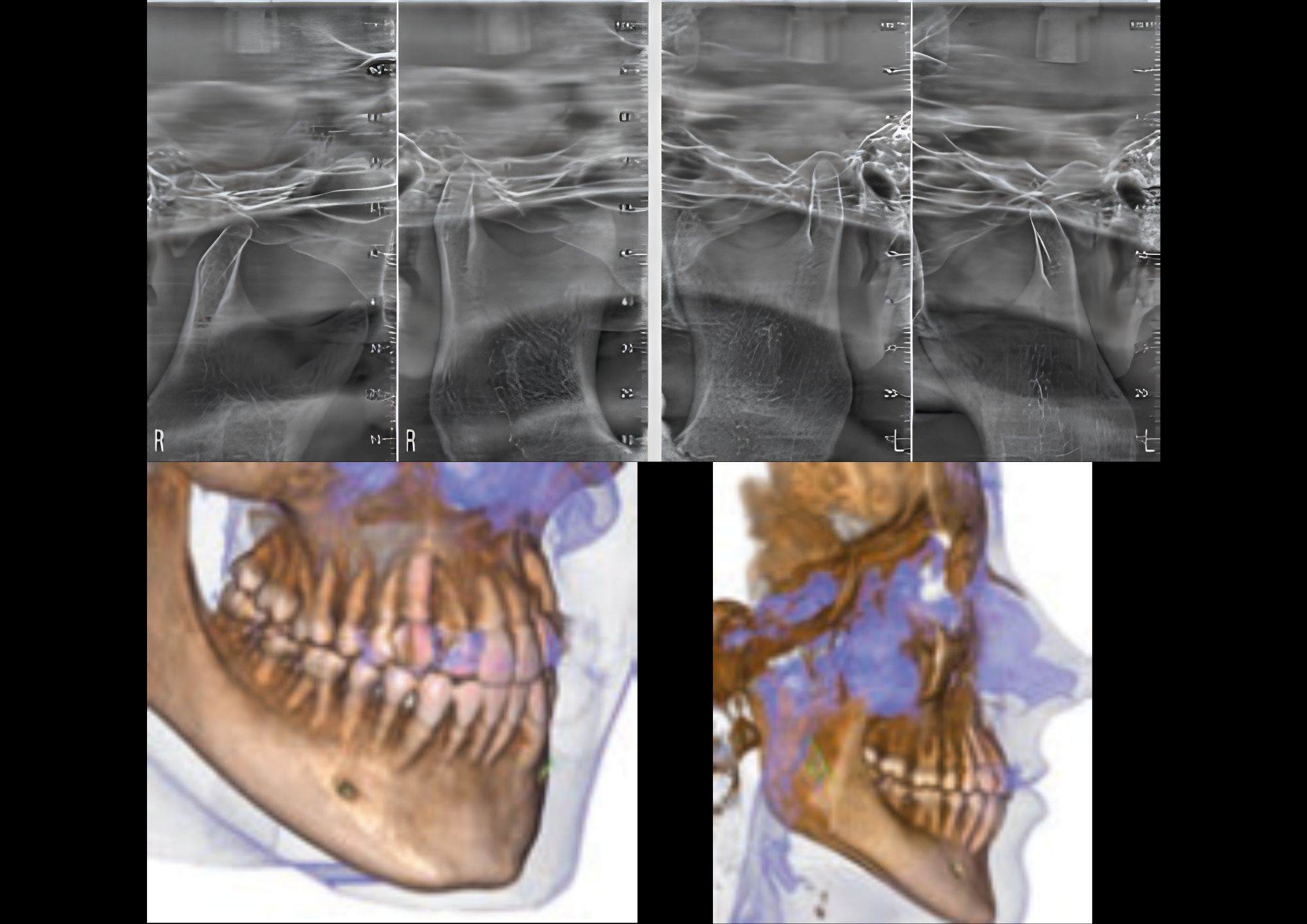 Hình ảnh CBCT TMJ và Cervical Spine trên MyRay Hyperion X9 Pro với FOV XF 7×6 cm và 9×9 cm, hỗ trợ đánh giá khớp thái dương hàm và đốt sống cổ ở độ phân giải lên đến 68 µm.