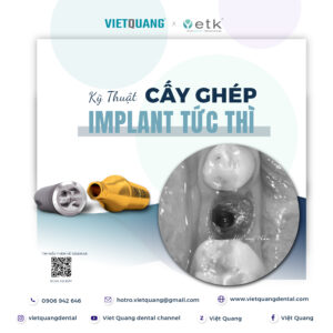 cấy ghép implant tức thì