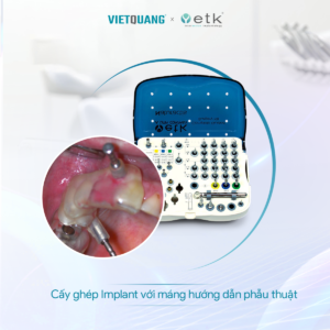 KỸ THUẬT SỐ TRONG CẤY GHÉP IMPLANT