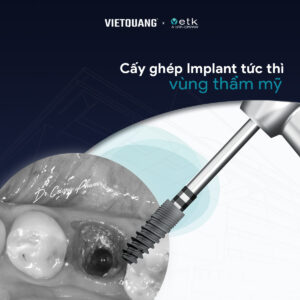 cấy ghép implant tức thì