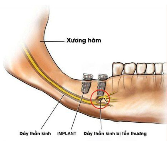 biến chứng sau khi cấy implant
