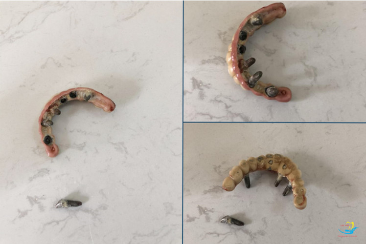 biến chứng sau khi cấy implant