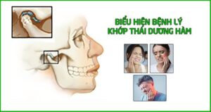 viêm khớp thái dương