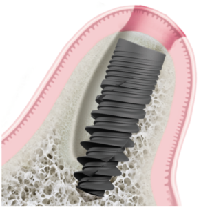 cắm implant