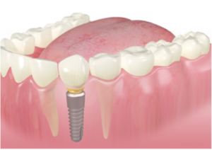 cắm implant