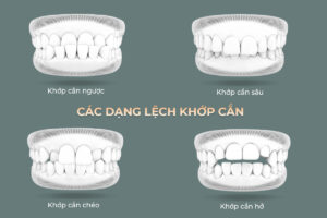 lệch khớp cắn
