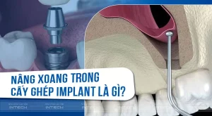 nâng xoang trong cấy ghép implant