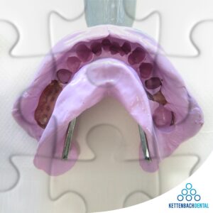 Lấy dấu răng chính xác sẽ tối ưu hóa các bước điều trị tiếp theo