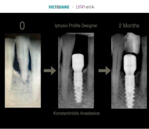Quy trình cấy ghép có thể nhanh chóng hơn với các bộ đôi Implant ETK & iPhysio