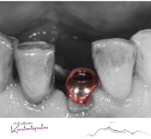 Implant chắc chắn là lựa chọn đáng cân nhắc khi bạn đang tìm một giải pháp lâu dài