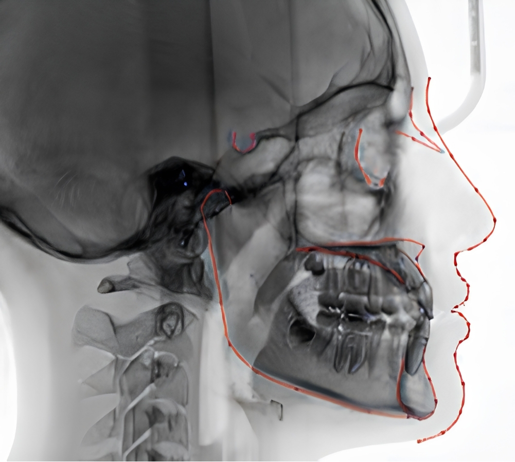 Hình ảnh chụp Cephalometric bằng máy X-quang CBCT MyRay Hyperion X5