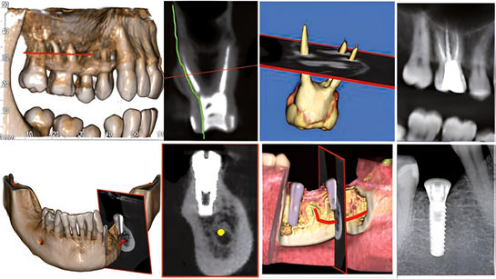 Hình ảnh CBCT Hyperion X5 chẩn đoán nội nha độ phân giải cao