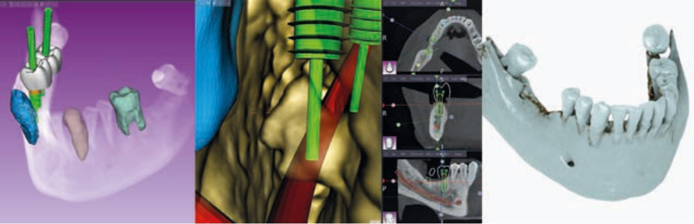 MyRay RealGUIDE hỗ trợ lập kế hoạch Implant từ dữ liệu CBCT và STL